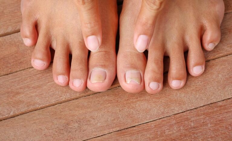 Wie man Zehennagelpilz mit Nagellack verbirgt